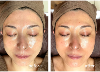 症例モニターの条件